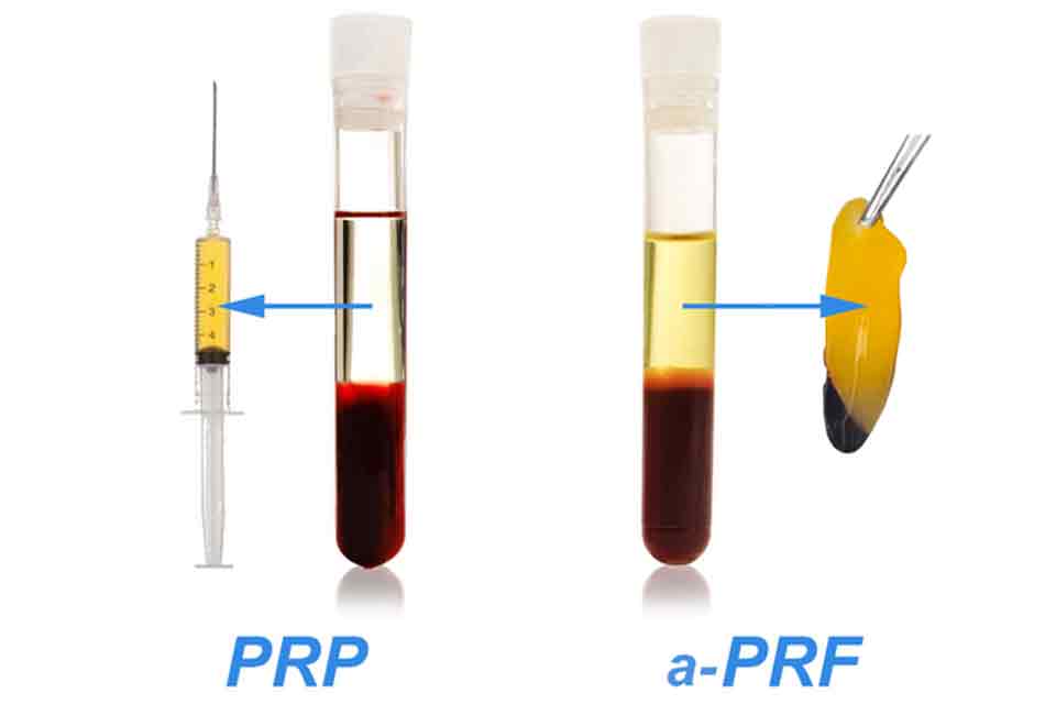 PRF چیست و چه تفاوتی با PRP دارد؟